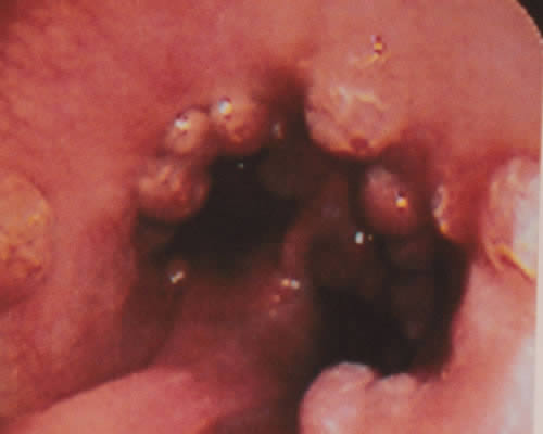 endoscopia rigida e flessibile